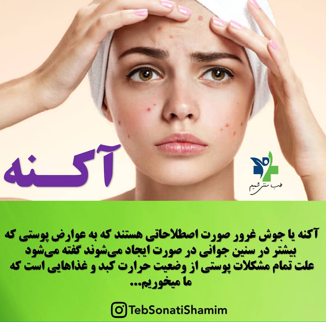 درمان جوش و آکنه روی صورت با طب سنتی