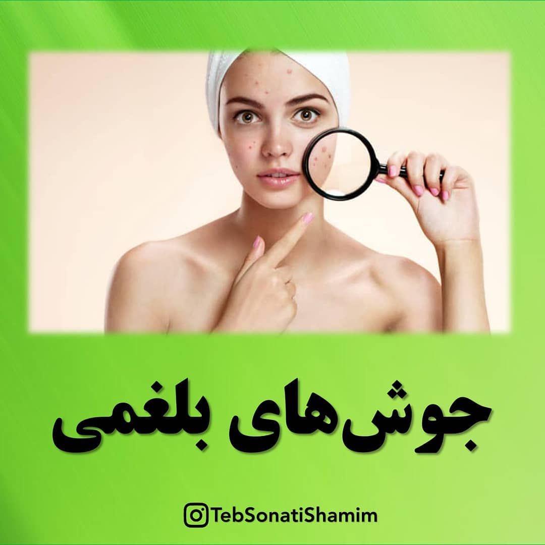 جوش بلغمی | درمان جوش بلغمی