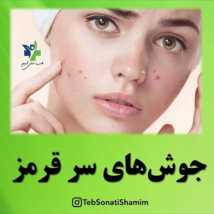 درمان جوش سرقرمز با طب سنتی