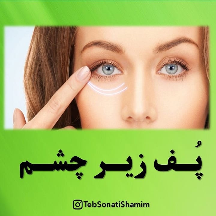 پف زیرچشم | درمان پف زیرچشم