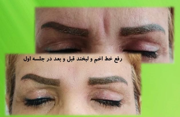 کربوکسی تراپی