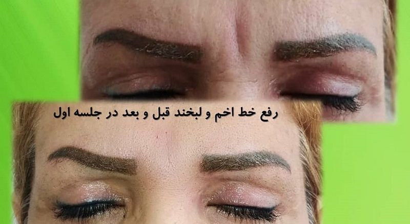 کربوکسی تراپی