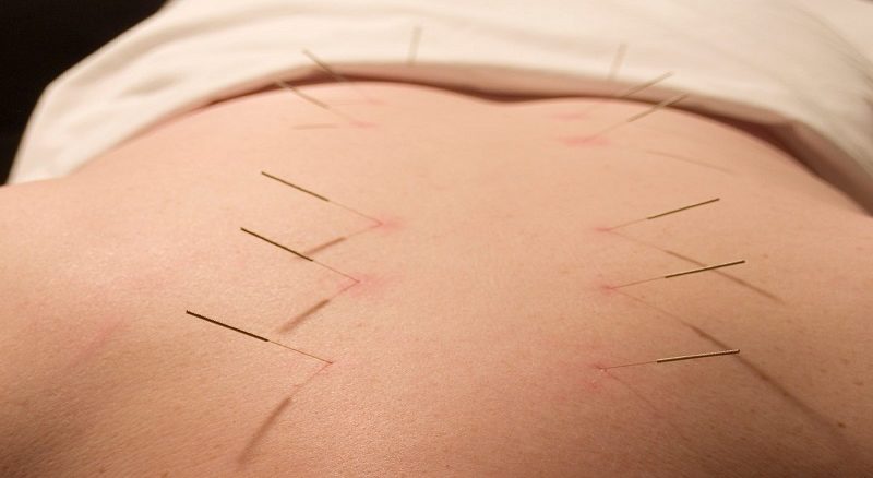 چه زمانی برای انجام طب سوزنی مناسب است؟