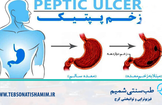 درمان بیماری گوارشی