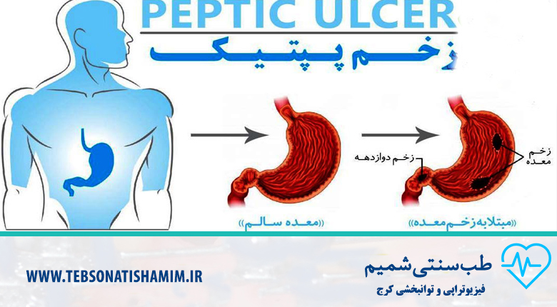 درمان بیماری گوارشی