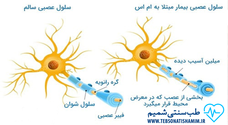 درمان ام اس در طب سنتی