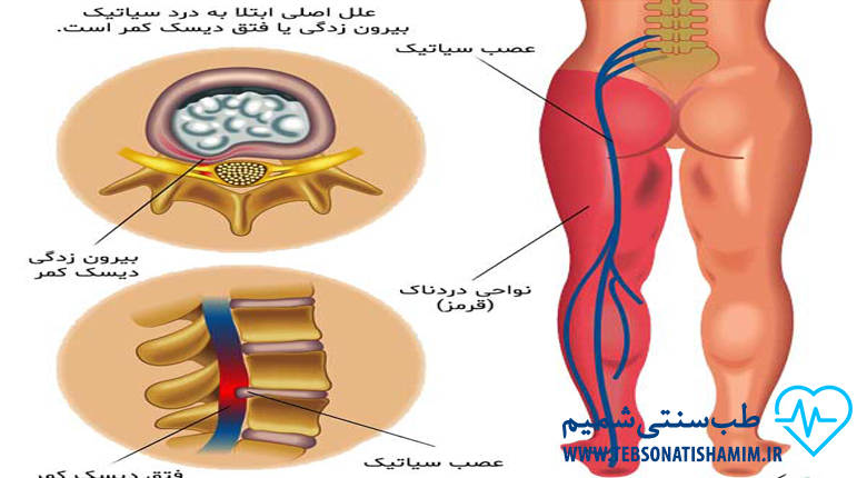 رفع درد سیاتیک