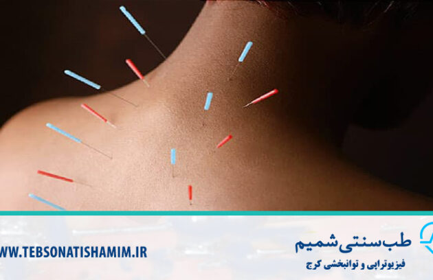 طب سوزنی کرج