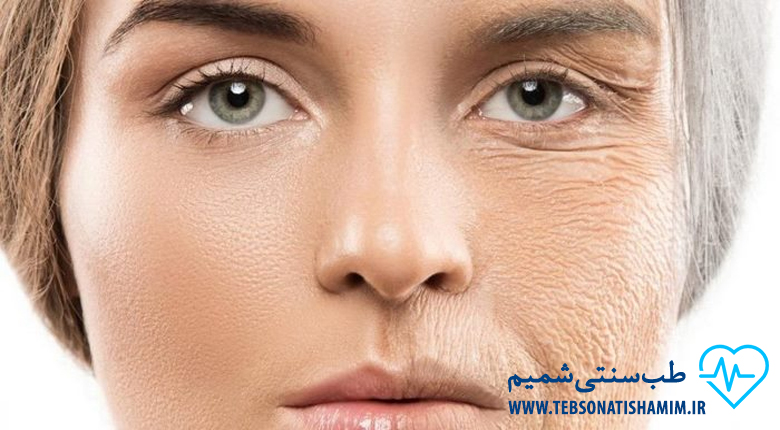 کرم های چین و چروک