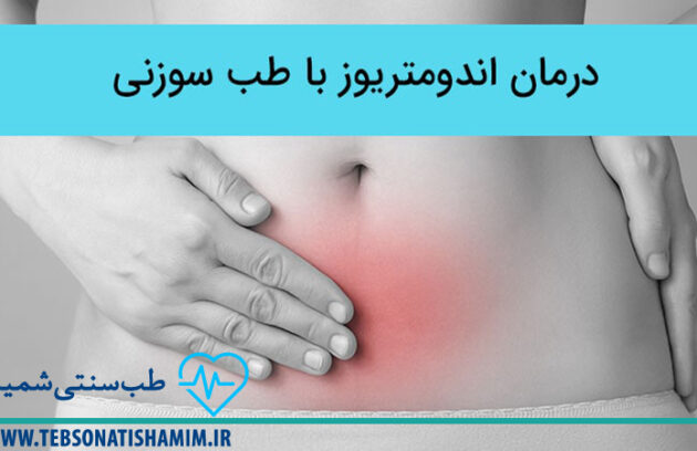 تسکین درد ناشی از اندومتریوز با طب سوزنی