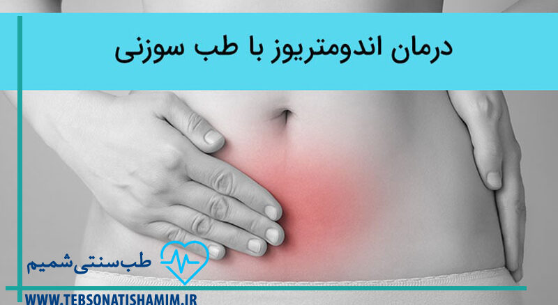تسکین درد ناشی از اندومتریوز با طب سوزنی