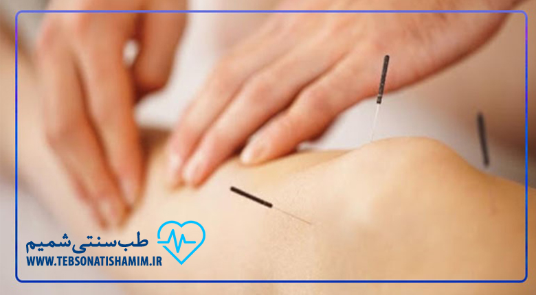 تسکین درد ناشی از اندومتریوز با طب سوزنی