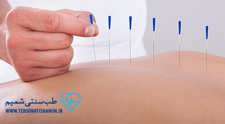 طب سوزنی برای درمان بیماری های دستگاه گوارش