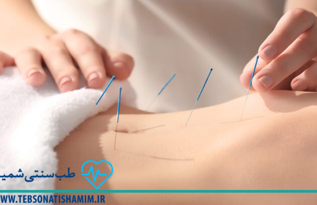 طب سوزنی برای درمان بیماری های دستگاه گوارش