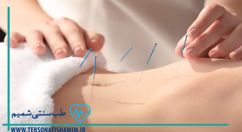 طب سوزنی برای درمان بیماری های دستگاه گوارش