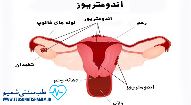 تسکین درد ناشی از اندومتریوز با طب سوزنی
