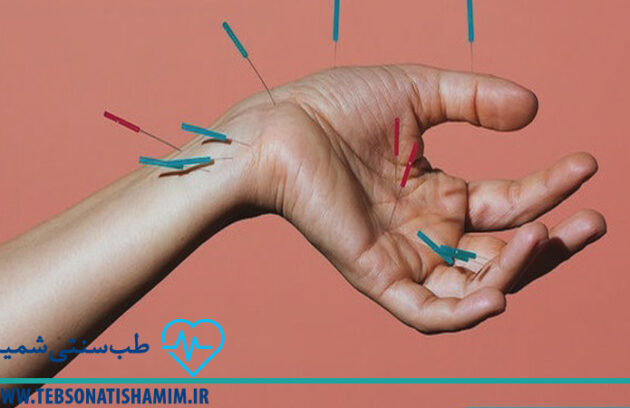 تسکین درد سیاتیک با طب سوزنی