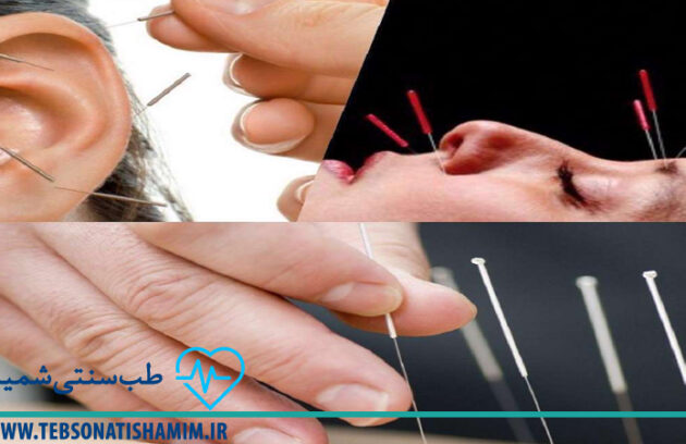 کاهش وزن با طب سوزنی