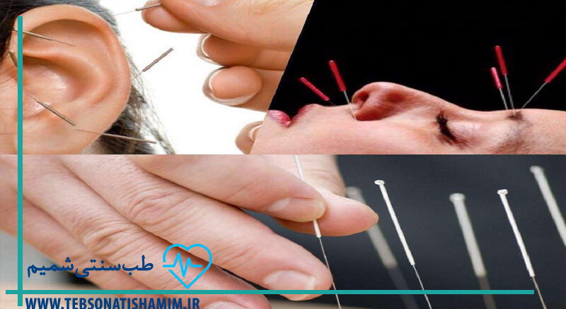 کاهش وزن با طب سوزنی