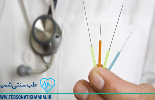 درمان تهوع صبحگاهی با طب سوزنی