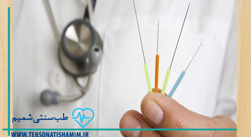درمان تهوع صبحگاهی با طب سوزنی