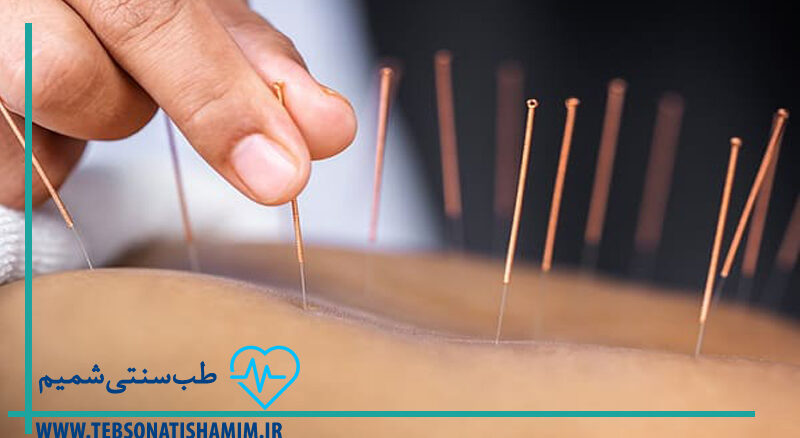 فواید طب سوزنی