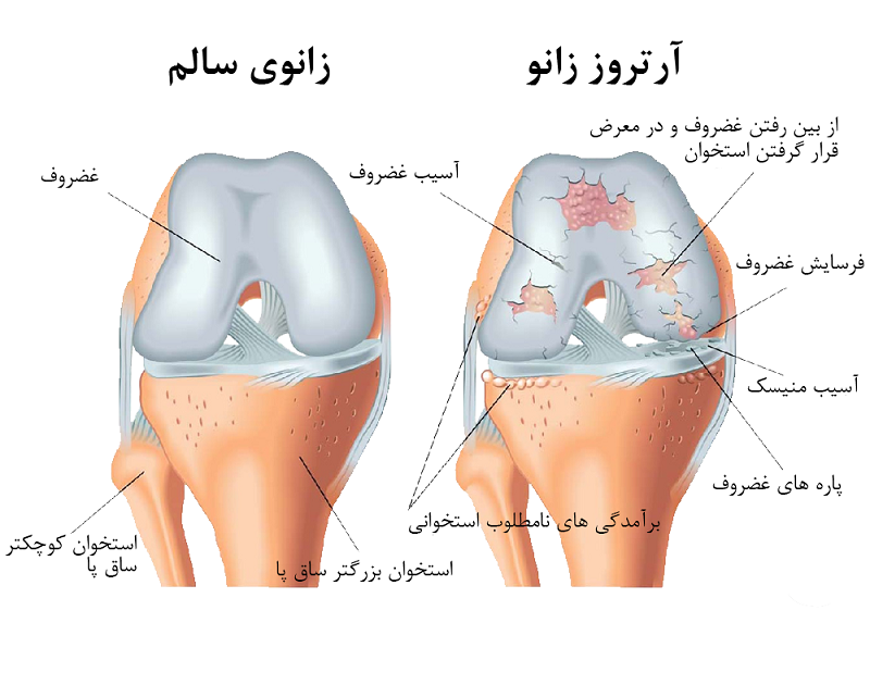 درمان زانو درد