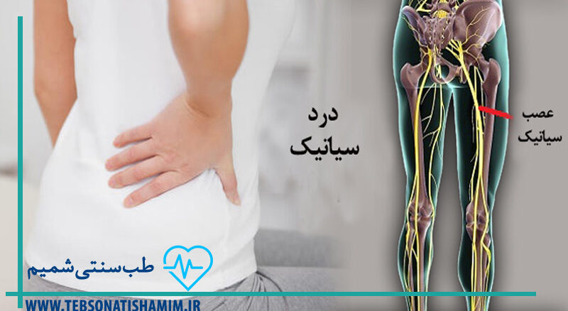 عصب سیاتیک