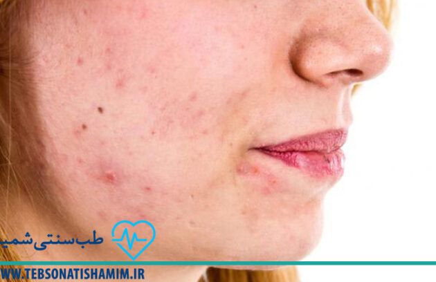 فیزیوتراپی و توانبخشی کرج | طب سوزنی در کرج