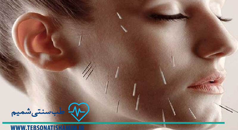 فیزیوتراپی و توانبخشی کرج | طب سوزنی در کرج