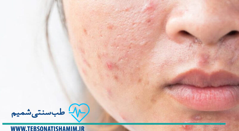 فیزیوتراپی و توانبخشی کرج | طب سوزنی در کرج