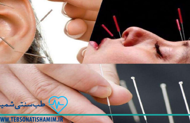 فیزیوتراپی و توانبخشی کرج | طب سوزنی در کرج
