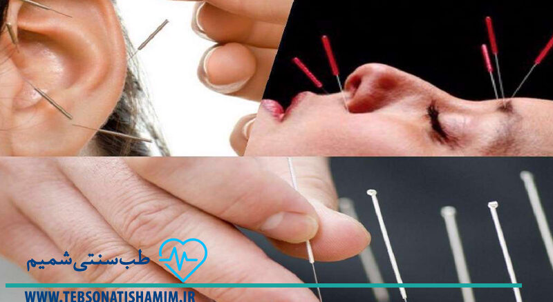 فیزیوتراپی و توانبخشی کرج | طب سوزنی در کرج