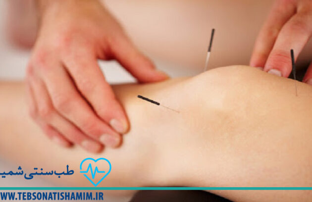 فیزیوتراپی و توانبخشی کرج | طب سوزنی در کرج