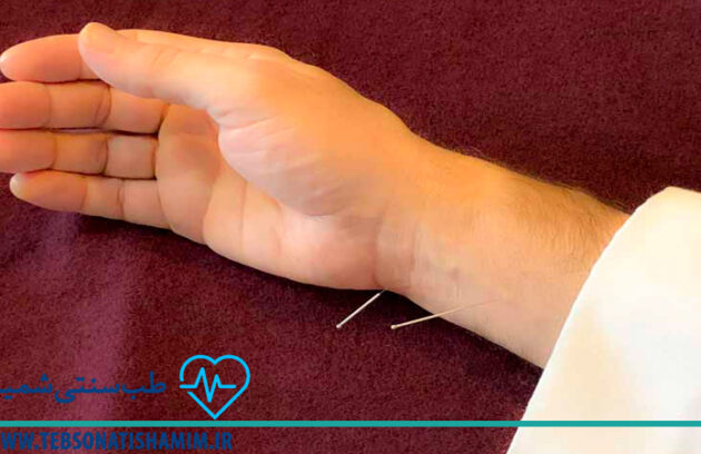فیزیوتراپی و توانبخشی کرج | طب سوزنی در کرج