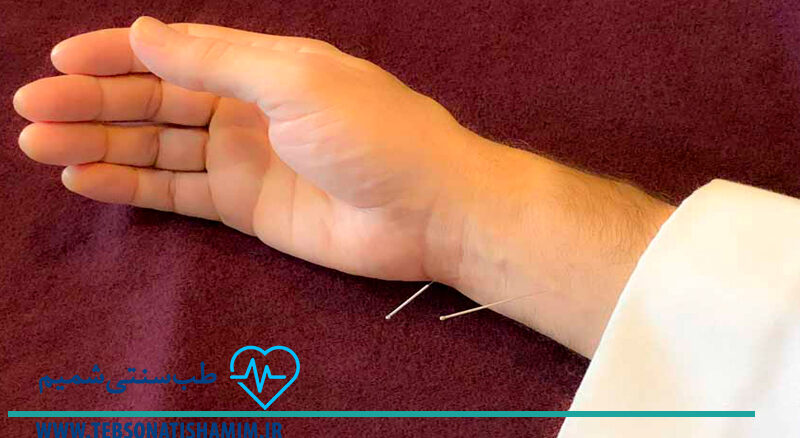 فیزیوتراپی و توانبخشی کرج | طب سوزنی در کرج