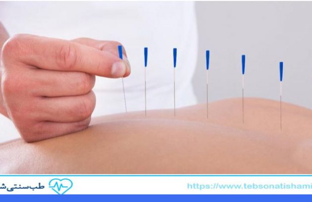 طب سوزنی و نقش آن بر سیستم عصبی