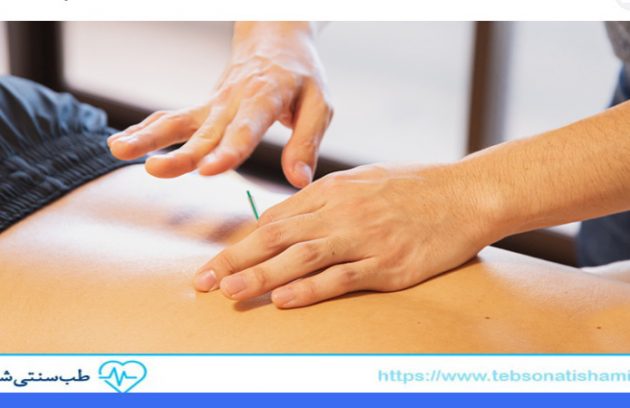 بهترین روش های طب سوزنی