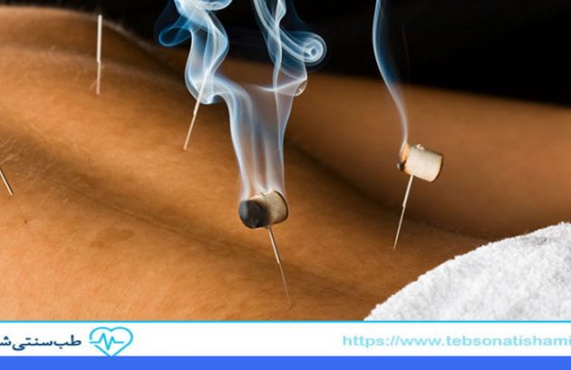 مراقبت بعد از طب سوزنی