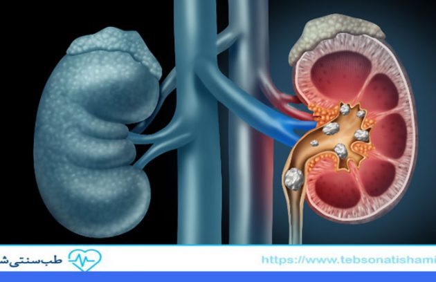 روش های جلوگیری از بروز سنگ کلیه