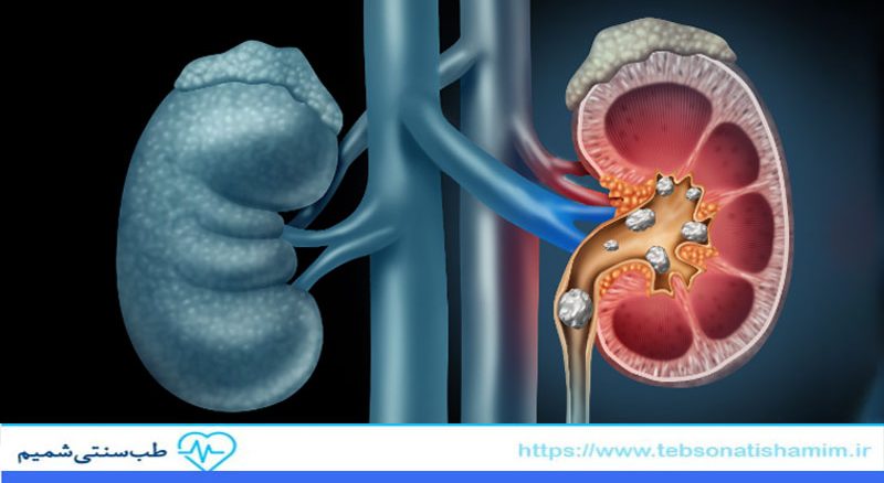 روش های جلوگیری از بروز سنگ کلیه