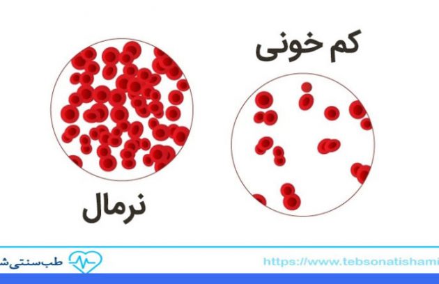 درمان کم خونی در طب سنتی