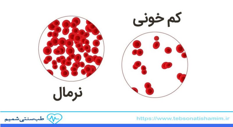 درمان کم خونی در طب سنتی