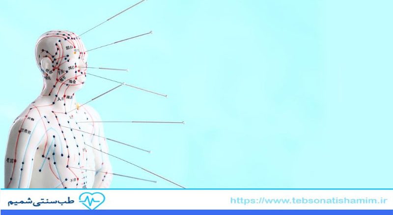 طب سوزنی و کاهش درد