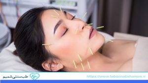 جوانسازی صورت با طب سوزنی