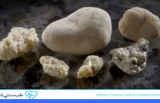 پیشگیری از سنگ کلیه با تغذیه سنتی