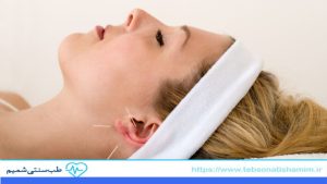 تقویت حافظه با طب سوزنی