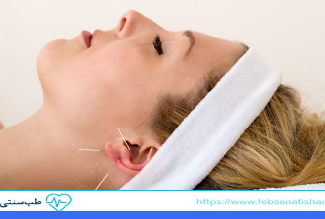 تقویت حافظه با طب سوزنی