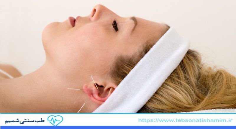 تقویت حافظه با طب سوزنی