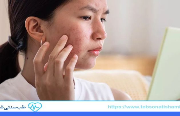 رفع لک صورت با طب سنتی